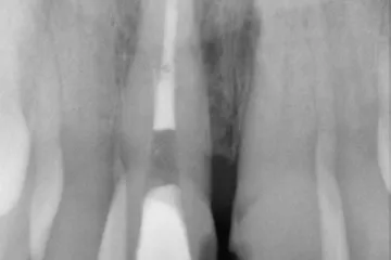 La radiografia di un incisivo con il canale della radice otturato