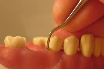 Uno scaler parodontale appoggiato al colletto di un dente, su un modello delle arcate