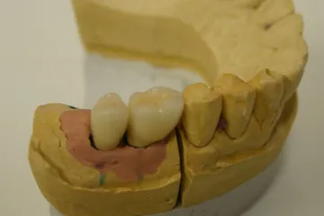 Un ponte di due corone su un modello in gesso delle arcate
