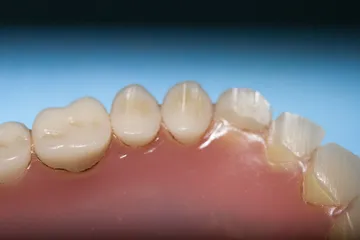 L'arcata di una protesi totale, con i denti in resina sulla gengiva rosa
